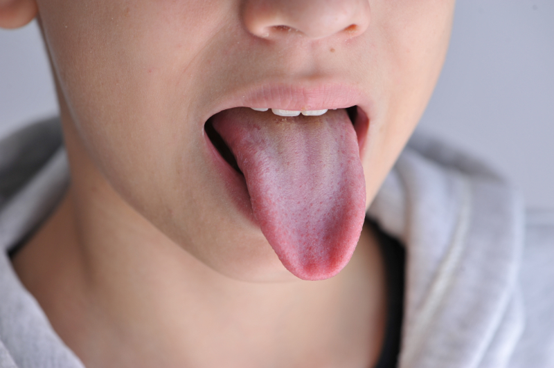 舌痛症の症状がでてきた人