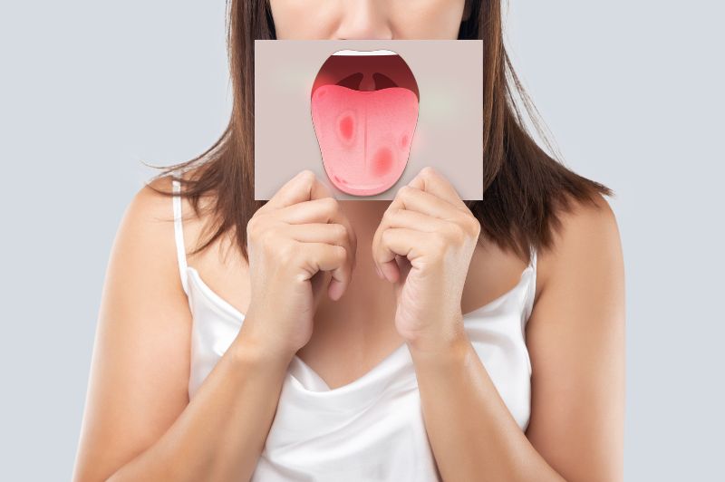 口内炎と舌癌