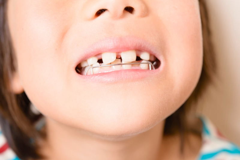 すきっ歯で矯正治療している子どもの口元
