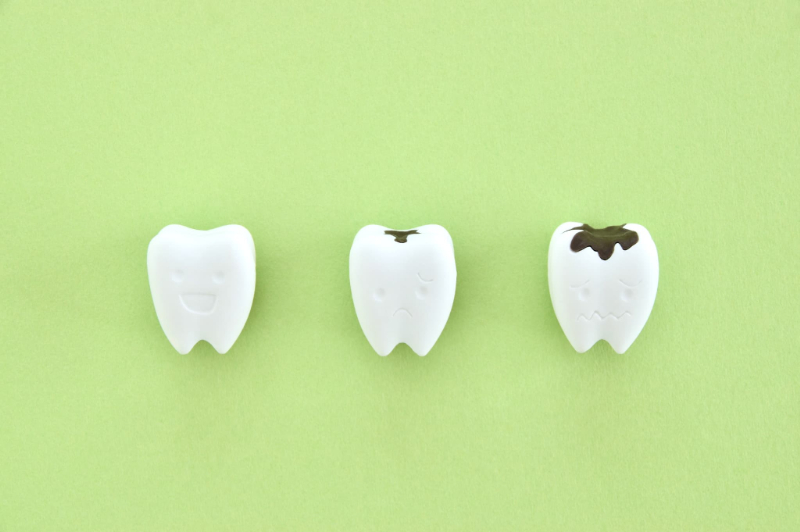 虫歯の進行段階のイメージ