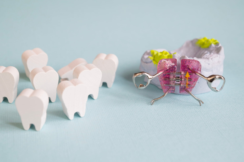 歯の模型と床矯正の装置