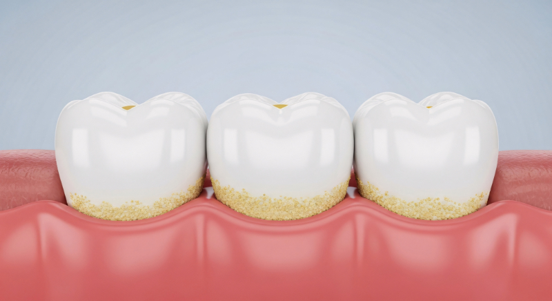 蓄積したプラークのイメージ