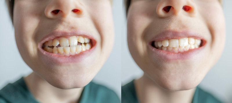 小児矯正をする前後のイメージ