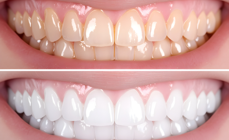 ホワイトニングビフォーアフター