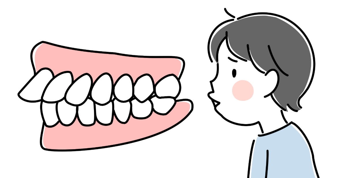 子どもの出っ歯の様子