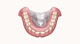 金属床義歯