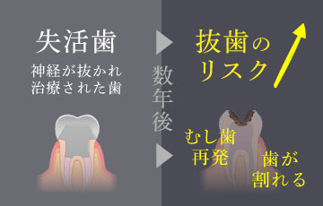 神経が抜かれ治療された歯は、数年後にむし歯が再発・歯が割れるなどで抜歯のリスクが高い